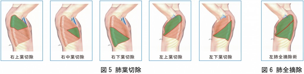 左：肺葉切除　右：肺全摘除